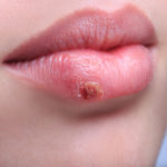 Fieberbläschen an der Lippe - Herpes vorbeugen