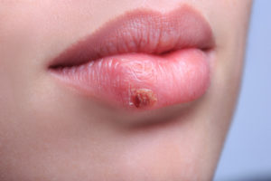 Fieberbläschen an der Lippe - Herpes vorbeugen