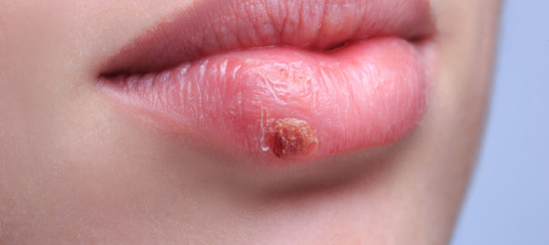 Fieberbläschen an der Lippe - Herpes vorbeugen