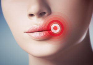 lippenherpes durch stress